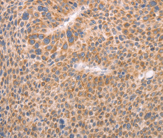 Immunohistochemistry of paraffin-embedded Human liver cancer using AASDHPPT Polyclonal Antibody at dilution of 1:30