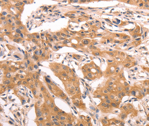 Immunohistochemistry of paraffin-embedded Human lung cancer using AASDHPPT Polyclonal Antibody at dilution of 1:30