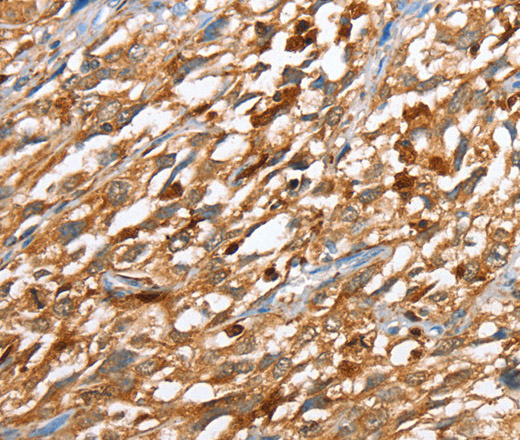Immunohistochemistry of paraffin-embedded Human esophagus cancer using CAPG Polyclonal Antibody at dilution of 1:40