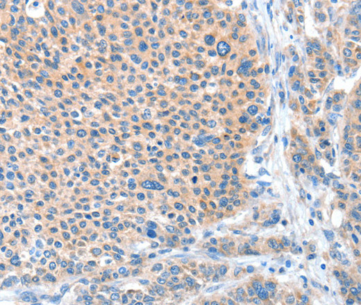 Immunohistochemistry of paraffin-embedded Human liver cancer tissue using ADAM20 Polyclonal Antibody at dilution 1:50