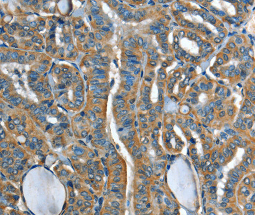 Immunohistochemistry of paraffin-embedded Human thyroid cancer tissue using ADCY4 Polyclonal Antibody at dilution 1:45