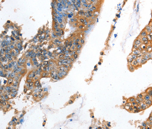 Immunohistochemistry of paraffin-embedded Human colon cancer using AKR1D1 Polyclonal Antibody at dilution of 1:35