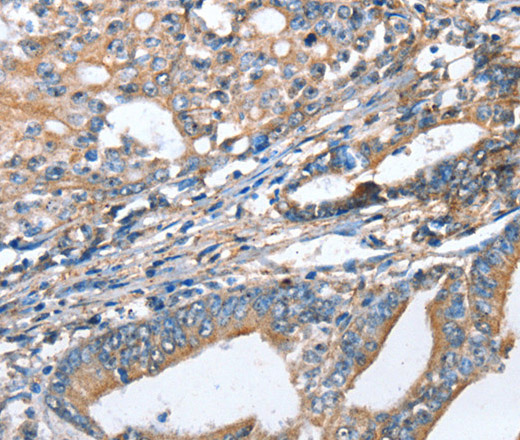 Immunohistochemistry of paraffin-embedded Human gastric cancer using AKR1D1 Polyclonal Antibody at dilution of 1:35