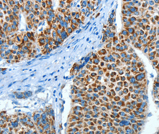 Immunohistochemistry of paraffin-embedded Human liver cancer using ALDH4A1 Polyclonal Antibody at dilution of 1:45