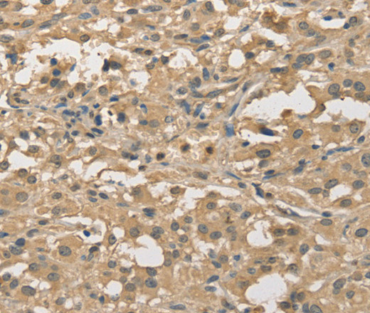 Immunohistochemistry of paraffin-embedded Human thyroid cancer using ALDH8A1 Polyclonal Antibody at dilution of 1:30