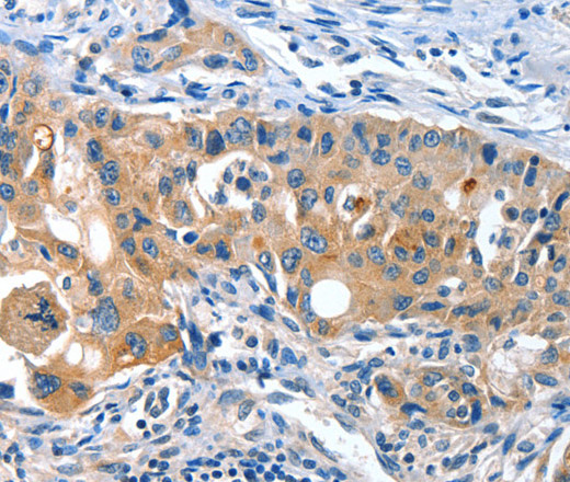 Immunohistochemistry of paraffin-embedded Human lung cancer tissue using AMHR2 Polyclonal Antibody at dilution 1:40