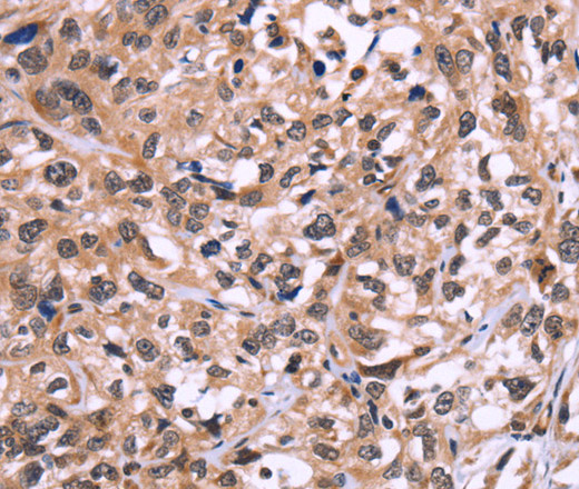 Immunohistochemistry of paraffin-embedded Human esophagus cancer using AMIGO2 Polyclonal Antibody at dilution of 1:50