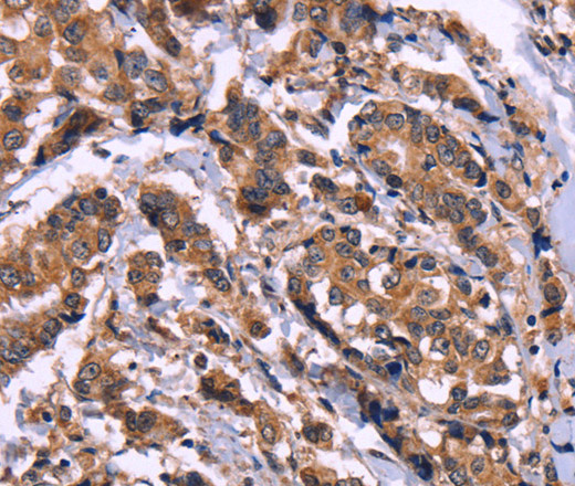 Immunohistochemistry of paraffin-embedded Human breast cancer using AMIGO2 Polyclonal Antibody at dilution of 1:50