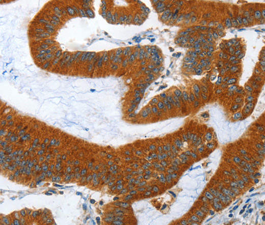 Immunohistochemistry of paraffin-embedded Human colon cancer tissue using ANAPC10 Polyclonal Antibody at dilution 1:40