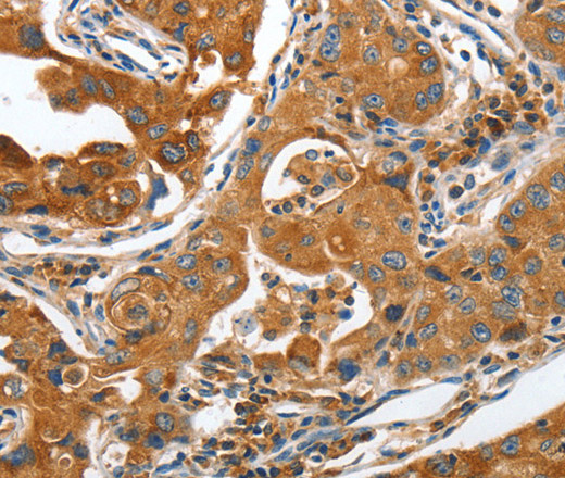 Immunohistochemistry of paraffin-embedded Human lung cancer tissue using ANAPC10 Polyclonal Antibody at dilution 1:40