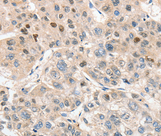 Immunohistochemistry of paraffin-embedded Human liver cancer tissue using APC5 Polyclonal Antibody at dilution 1:30