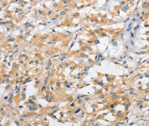 Immunohistochemistry of paraffin-embedded Human thyroid cancer using ATG10 Polyclonal Antibody at dilution of 1:60