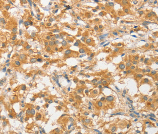 Immunohistochemistry of paraffin-embedded Human thyroid cancer using ATG5 Polyclonal Antibody at dilution of 1:40