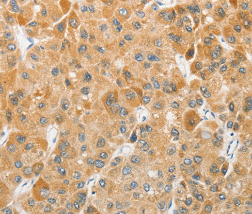 Immunohistochemistry of paraffin-embedded Human liver cancer using ATG5 Polyclonal Antibody at dilution of 1:40