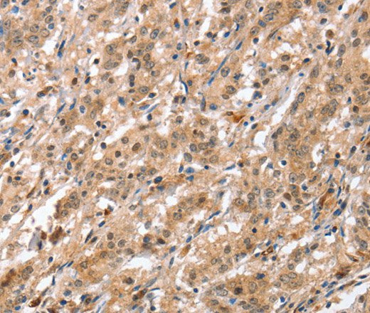 Immunohistochemistry of paraffin-embedded Human gastric cancer tissue using ATG12 Polyclonal Antibody at dilution 1:70