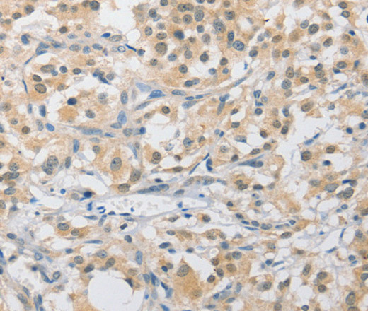 Immunohistochemistry of paraffin-embedded Human thyroid cancer tissue using APLF Polyclonal Antibody at dilution 1:40