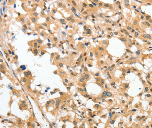 Immunohistochemistry of paraffin-embedded Human thyroid cancer tissue using APTX Polyclonal Antibody at dilution 1:50