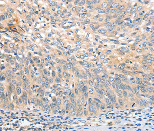 Immunohistochemistry of paraffin-embedded Human cervical cancer tissue using APTX Polyclonal Antibody at dilution 1:50