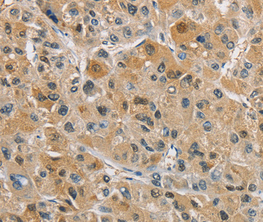 Immunohistochemistry of paraffin-embedded Human liver cancer tissue using NAPSA Polyclonal Antibody at dilution 1:40