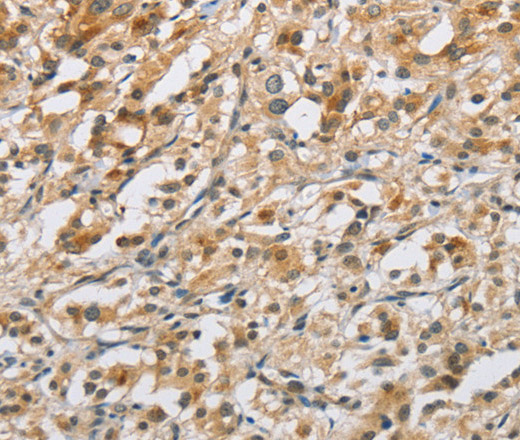 Immunohistochemistry of paraffin-embedded Human thyroid cancer tissue using NAPSA Polyclonal Antibody at dilution 1:40