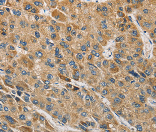 Immunohistochemistry of paraffin-embedded Human liver cancer tissue using MIP Polyclonal Antibody at dilution 1:60