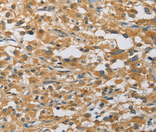 Immunohistochemistry of paraffin-embedded Human thyroid cancer tissue using MIP Polyclonal Antibody at dilution 1:60