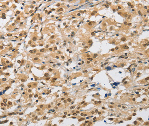 Immunohistochemistry of paraffin-embedded Human thyroid cancer tissue using AMZ2 Polyclonal Antibody at dilution 1:40