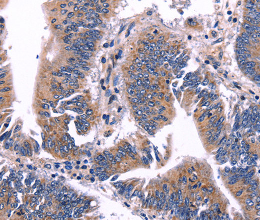 Immunohistochemistry of paraffin-embedded Human colon cancer tissue using ARC Polyclonal Antibody at dilution 1:50