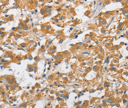 Immunohistochemistry of paraffin-embedded Human thyroid cancer using ARHGAP15 Polyclonal Antibody at dilution of 1:50