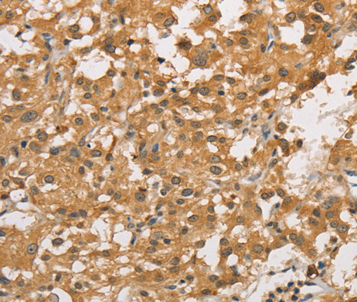 Immunohistochemistry of paraffin-embedded Human thyroid cancer using ARHGEF5 Polyclonal Antibody at dilution of 1:50