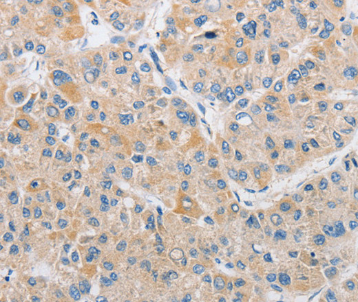 Immunohistochemistry of paraffin-embedded Human liver cancer tissue using ARHGEF9 Polyclonal Antibody at dilution 1:50