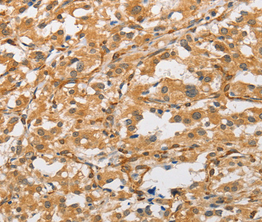 Immunohistochemistry of paraffin-embedded Human thyroid cancer tissue using ARMCX1 Polyclonal Antibody at dilution 1:40