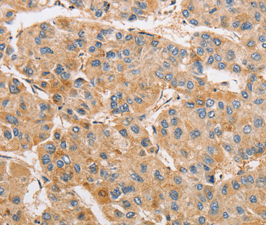 Immunohistochemistry of paraffin-embedded Human liver cancer tissue using ARMCX1 Polyclonal Antibody at dilution 1:40