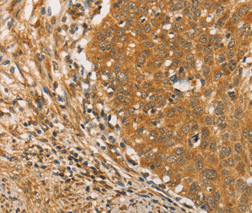 Immunohistochemistry of paraffin-embedded Human cervical cancer tissue using ARMCX3 Polyclonal Antibody at dilution 1:40