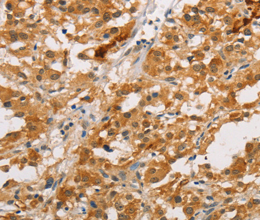 Immunohistochemistry of paraffin-embedded Human thyroid cancer tissue using ARMCX3 Polyclonal Antibody at dilution 1:40