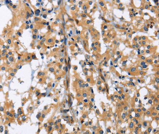 Immunohistochemistry of paraffin-embedded Human thyroid cancer tissue using GAB1 Polyclonal Antibody at dilution 1:40