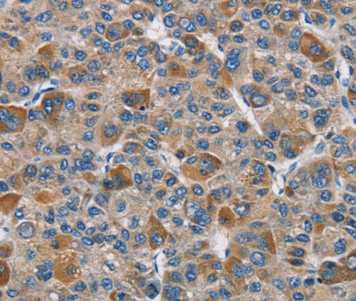 Immunohistochemistry of paraffin-embedded Human liver cancer tissue using DNMT3A Polyclonal Antibody at dilution 1:50