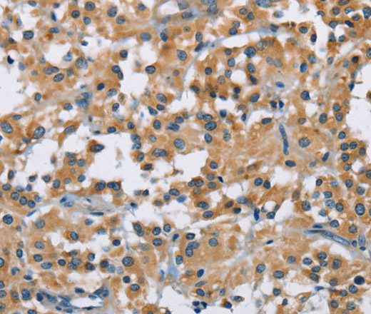 Immunohistochemistry of paraffin-embedded Human thyroid cancer tissue using DNMT3A Polyclonal Antibody at dilution 1:50