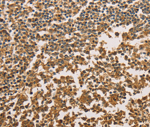 Immunohistochemistry of paraffin-embedded Human tonsil tissue using SETD2 Polyclonal Antibody at dilution 1:40