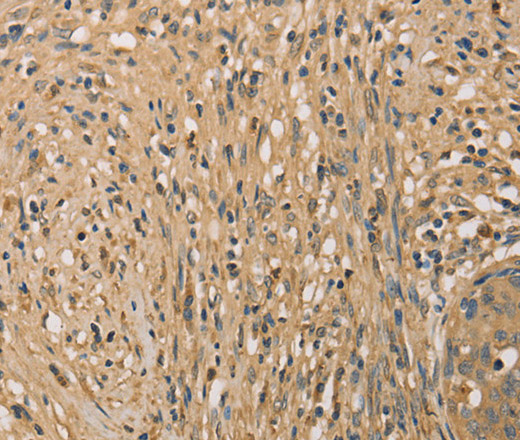 Immunohistochemistry of paraffin-embedded Human cervical cancer tissue using SETD2 Polyclonal Antibody at dilution 1:40