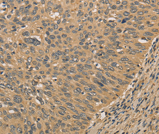 Immunohistochemistry of paraffin-embedded Human cervical cancer tissue using PRDM14 Polyclonal Antibody at dilution 1:30