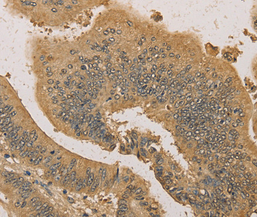 Immunohistochemistry of paraffin-embedded Human colon cancer tissue using PRDM14 Polyclonal Antibody at dilution 1:30