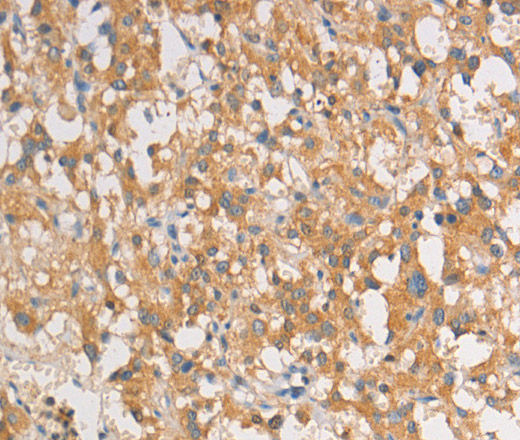 Immunohistochemistry of paraffin-embedded Human thyroid cancer tissue using ART3 Polyclonal Antibody at dilution 1:40