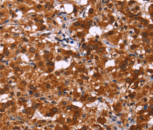 Immunohistochemistry of paraffin-embedded Human thyroid cancer tissue using ART5 Polyclonal Antibody at dilution 1:50