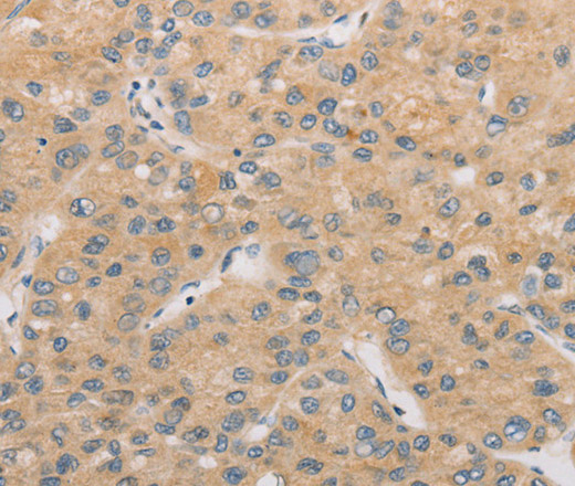 Immunohistochemistry of paraffin-embedded Human liver cancer tissue using ATG4D Polyclonal Antibody at dilution 1:40