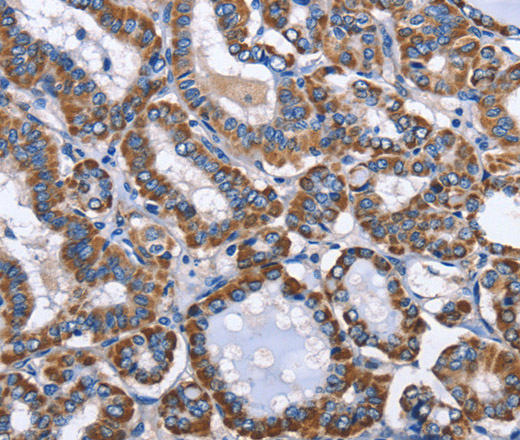 Immunohistochemistry of paraffin-embedded Human thyroid cancer using INTS10 Polyclonal Antibody at dilution of 1:50