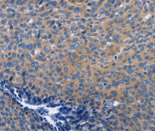 Immunohistochemistry of paraffin-embedded Human cervical cancer using INTS10 Polyclonal Antibody at dilution of 1:50