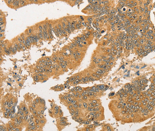 Immunohistochemistry of paraffin-embedded Human colon cancer tissue using BCL2L14 Polyclonal Antibody at dilution 1:40