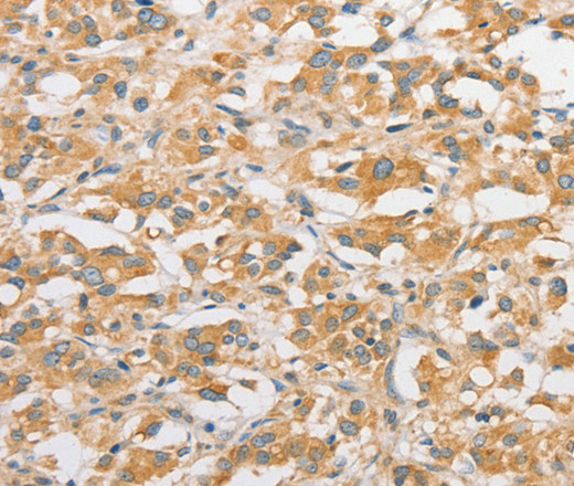 Immunohistochemistry of paraffin-embedded Human thyroid cancer tissue using TLR5 Polyclonal Antibody at dilution 1:30