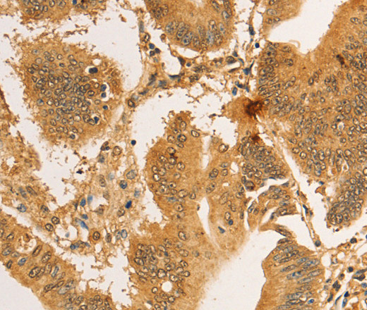 Immunohistochemistry of paraffin-embedded Human colon cancer tissue using RPL26L1 Polyclonal Antibody at dilution 1:30